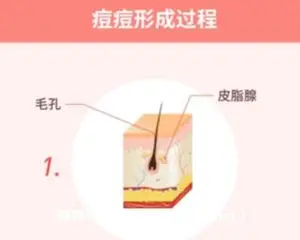 丁香妈妈 科学战痘攻略（完结）网盘下载