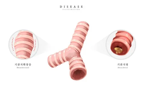 医院呼吸系统支气管炎研究医学疾病器官插画素材
