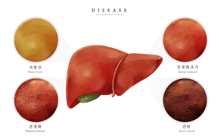 医院肝硬化肝脏肝癌胆囊脂肪肝研究医学疾病器官插画素材