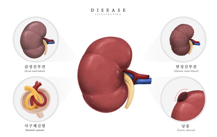 医院急性肾功能衰竭囊肿肾炎研究医学疾病器官插画素材