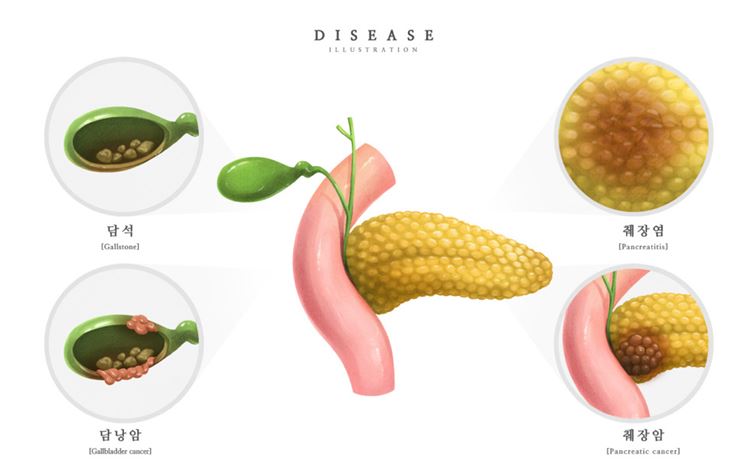 医院肝胰腺胰腺癌胰腺炎研究医学疾病器官插画素材