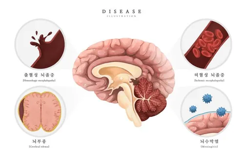 医院脑水肿脑膜炎中风脑出血脑血管研究医学疾病器官插画素材