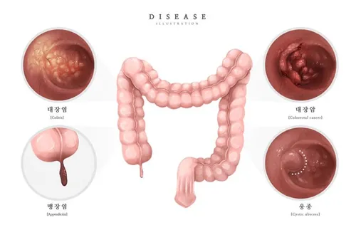 医院结肠癌阑尾炎研究医学疾病器官插画素材