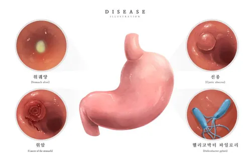 医院内窥镜胃溃疡胃癌幽门螺旋杆菌研究医学疾病器官插画素材
