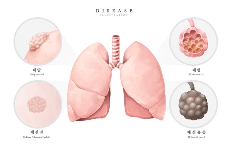 医院肺病肺结核肺纤维化肺癌呼吸系统支气管炎研究医学疾病器官插画素材